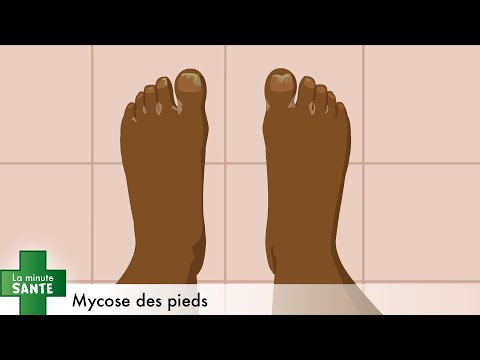 Mycose des pieds